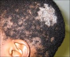 Causative: daycare age, pediatric, contact with infected items (combs, brushes, hat), poor hygiene, infected pets


Symptoms: Round,  scaly patches on scalp; patches of alopecia with visible black dots; pruritus; may   develop alopecia. Hair break...