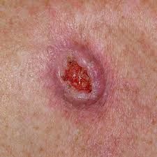 Causative: sun exposure (usually head and neck); areas of radiodermatitis; predisposition 


Symptoms: skin eruption irregular flaky; indurated papule, plaque or nodule; may be eroded, crusted or ulcerated


Differentials: can be associated HPV, i...