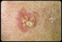 Causative: UV radiation, hx of sunburn, fair skinned, increase in age, affects men


Symptoms: solitary/multiple lesions on highly exposed ares; erythematous scaly macule, papule or plaque.


Differentials: visual or touch biopsy


Description: pr...