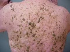 Causative: epidermal tumors; proliferation of benign, immature keratinocytes

Symptoms: well demarcated, round or oval lesions; dull, verrucous surface; usually located on scalp, behind ears, thigh creases and eyebrows; usually asymptomatic

Diffe...