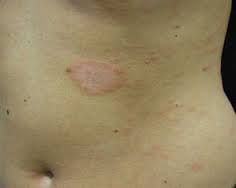 Causative: oval erythematous lesions; ovals line up along cleavage lines on trunk ("Christmas tree")


Symptoms: rarely on face; more common in spring and fall


Differentials: if present on palms and/or soles feet and hx warrants check syphilis

...