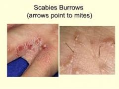 Causative: Sarcoptes scabiei (mite) allergic reaction to burrowing


Symptoms: nocturnal pruritus; usually axillae, webs of fingers and toes, intragluteal are
