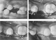 Extract ankylosed primary molar. Move the 4 posteriorly, converting it into 5. The process of moving the 4 distally will improve the bone deficiency caused by the ankylosis. The space where the 4 previously occupied now because the space for the i...