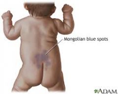 Appearance: darker skinned infants, blue/gray spots (look like bruise) found on back, buttocks, upper legs.


Implications: no risks, may appear abused but not; congenital dermal melanocytosis; asians


Anticipatory Guidance: attentive to document...