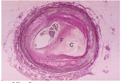 - histo slide of plaqueF: fibrous cap, C: necrotic lipid core