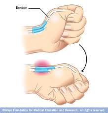 With the thumb inside the palm, the wrist and hand are flexed medially(ulnar deviation), causing pain in the abductor tendons of the thumb at theradial styloid. A positive result indicates de Ouervain's tendonitis of thewrist. 