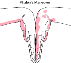 Flexion of the wrist produces the paraesthesia/pain of mediannerve compression at the wrist (carpal tunnel syndrome). The reversePhalen maneuver involves hyperextension of the wrist with the resultantmedian nerve paraesthesias.