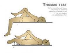 Pt supine and flexes hip.  Place hand under small of  back to determine that the lumbarspine has flattened out onto the bed. If the test hip remains on the bedthen there is no deformity. If test hip raises off the bed fixed flexion deformity of th...