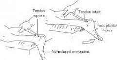 The patient is placed in a kneeling or prone position with the foot hangingfree over the end of the bed. The middle of the calf is squeezed. The test is positivewhere no ankle movement occurs and indicates a rupture of the Achilles.