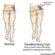 Weight is supported on affected limb x30 sec; the pelvis on thehealthy side falls instead of rising as in a normal hip. A positive test indicates gluteus medius weakness, afixed adduction contracture, short femoral neck or a dislocated hip. 