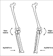 The patient is supine. Theknee is held at the ankle in 30° of flexion. With the other hand avalgising or varising force is applied to the appropriate side of the knee.Any angular giving way of the knee indicates a tear of the correspondingcollate...