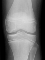 An 11-year-old boy presents with recurrent knee effusions and discomfort with athletic activity. A radiograph of the knee is shown in Figure A. What is the most important determinant of a successful outcome with nonoperative treatment?

1.  Weig...