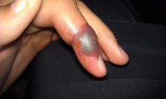 A 22-year-old college student presents with significant finger pain after coming into contact with liquid nitrogen in his chemistry lab. A clinical photo of the affected finger in shown in Figure A. What is the most appropriate next step in treatm...