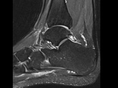 A 17-year-old ballet dancer presents with 5 months of pain in the posterior aspect of the right lower extremity that is exacerbated with the ballet position shown in Figure A. Her symptoms returned with ballet activity following a 1 month course o...