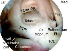 The history, examination, and imaging studies are consistent with os trigonum syndrome and is most appropriately surgically treated with arthroscopic or open excision. An os trigonum can cause impingement with plantar flexion of the foot, especial...