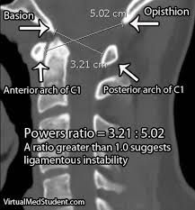 
	Down syndrome
	powers ratio= CD/AB 

CD a distance from the basion to the posterior arch and AB is distance from the anterior arch to the opisthion

	 ratio is = 1, However in the ratio is greater than 1concern for anterior dislocation
...