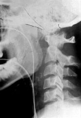 
	what is the most common cause of occipital cervical instability is nontraumatic?
	assess an x-ray for this diagnosis?
	what is the treatment?

