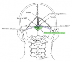 the most common complication is penetrating injury to the major dural venous sinus which is located just below the external occipital protuberance an approximately 10 mm from the midline of the skull