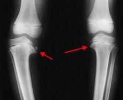 
	with physiologic bowing there is symmetric flaring of the tibia and femur compared to BLOUNT's disease which shows metaphyseal beaking
	greater than 16 is considered abnormal and has a 95% chance of progressing
	Less than 10° as a 95% chance...