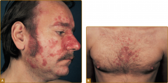 A 35 year old man new to your practice complains of a scaly, red rash that began suddenly and rapidly spread to involve his scalp, beard area and face. (See attached pictures). The man has never had anything like this before, and denies any new ...