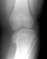 a child greater than 3 years of age with a stage II or 1 is treated with proximal tibia fibula valgus osteotomy and overcorrection of 10-15° of valgus