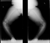 the child is greater than 3 years of age with stage III or 5 the treatment is proximal tibia and fibula valgus osteotomy with correction 10-15° of valgus