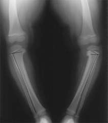 A 30-month-old boy has worsening bilateral bowleg deformities, and radiographs are shown in Figure A. The most appropriate initial management should consist of which of the following?
1.  Observation
2.  Full-time bracing with knee-ankle-foo...