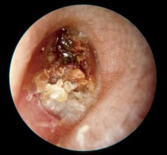 Karatosis obturans is a rapid accumulation of keratin debris, which may lead to a plugged external auditory canal.  May have painless erosion and expansion of external canal.  May be associated with drainage, foul odor and secondary external otiti...