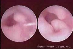 Associated with cold water exposure.

Lamellar thickening of bone of external ear canal.  Commonly involving the anterior and posterior canal wall. 

May cause canal stenosis, cerumen impaction, or limited exposure of the TM. 

Tx - canalopl...