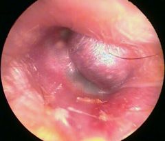 Soft, reddish or purple mass of external ear canal pulsating on microscopic examination. 

Capillary hamangioma usually involutes in childhood.
Cavernous does not involute and may extend to surrounding structures. 

Tx - aspiration; surgery r...