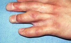 Web creep, the most common complication of this procedure, is the distal migration of the web commissure seen in surgically corrected syndactyly patients. It is caused by abnormal scar tissue formation and increasing growth of underlying osseous s...