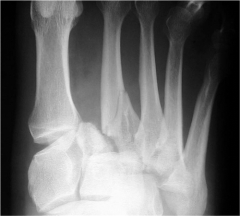  A 45-year-old male trauma patient presents with multiple extremity injuries including the foot injury shown in Figure A. The foot fracture is treated surgically, and heals without any initial complications. At a minimum of 12 months, this patien...
