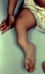 
	is associated with pseudoarthrosis of the tibia congenital & neurofibromatosis
	Treatment is not fractured brace and if pseudoarthrosis or fracture treated with surgical fixation,  IM nail with bone grafting or free fibular graft
