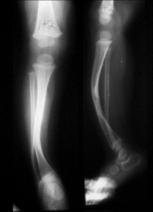 
	anterior lateral bowing of the tibia is associated with what condition?
	what is the treatment
