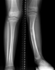
	anteromedial bowing of the tibia is associated with fibular hemimelia
	treatment is determined by #1 stability #2 level of involvement #3Ankle function #4 the amount of limb shortening#5 not the amount of fibula present
	Example plantigrade a...