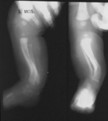 
	 medial anterior = fibula hemiamilia

posterior medial = physiologic bowing P2PM

	lateral anterior see the foot, pseudoarthrosis of the tibia, neurofibromatosis
