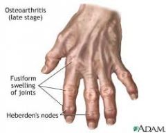 DIP joint
Thumb carpo-metacarparpal joints 
Knees 
 
Tenderness/Derangement/Bony swellings/ Decreased ROM/ Mild Synovitis 
 
BOUCHARDS
HEBERDENS
SQUARING of the Carpometacarpal joint of the thumb