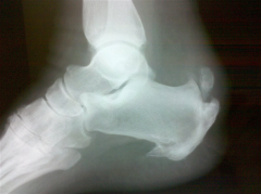 A 48-year-old male complains of 5 years of heel pain while running. Initially the pain was relieved with Achilles tendon stretching, orthotics, and open-backed shoe wear. Over the past year these modalities are no longer helpful and he is beginnin...