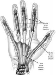 Flexor tendons of the fingers within Zone 2 receive their primary nutritional supply from: 1-Vinculae 
2-Phalangeal periosteum; 3-Musculotendon junction; 4-Tendon insertion; 5-Diffusion from the synovial sheath