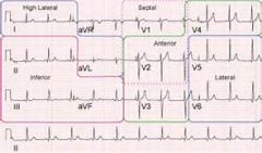 STEMI: 1mm elevation in 2 contiguous leads

 

Rhythm: P before every QRS (sinus)

Axis: if upright in I and AVF, nl!

 

Ischemia:

- flipped T waves: can be ischemia

- elevations: infarction

- depression: infarction opposite of that lead

 