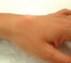 Hx:54yo M presents with a slowly enlarging mass on the dorsum of his L wrist which has been present x 3 yrs. He denies any significant symptoms. PE shows a 1 cm palpable mass. A MRI is shown in Figure A. A biopsy of this lesion would most likely s...
