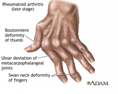 Early


- Inflammation / No joint damage: MCP/PIP/Wrist MTP/Bursitis/Tensosynovitis 


 


Late = JOINT DEFORMITY


1) Ulnar Deviation


2) Swan Neck Deformity


3) Boutonniere Deformity


4) Z-Deformity of the thumb


5) Rupture of the hand ext...