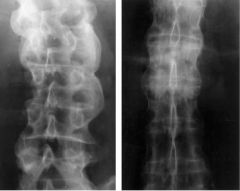 A 32-year-old man presents with low back and hip pain that has been gradually worsening over the past year. He reports the symptoms are worse in the morning. Radiographs are shown in Figure A. Laboratory studies show a positive HLA-B27. What addit...