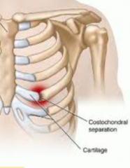 Costochondral injury
- compression of antero-lateral ribs cause a separation of cartilage & rib
- local tenderness
- swelling
- hematoma
- step off deformity (may have click)
- treat symptoms & protect area
