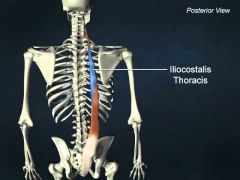 Intermediate Intrinsic Back Muscles: Iliocostalis (Erector Spinae)