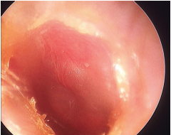 Ear pain, mild fever, unilateral hearing loss and a bulging tympanic membrane with distorted landmarks MOST LIKELY is