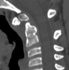  A 11-year-old male complains of one year duration of neck pain. He denies any recent trauma. He has noticed intermittent episodes of gait imbalance and difficulty with buttoning his shirt over the past 3 months. Physical exam shows normal streng...