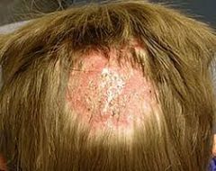 FUNGAL

aka ringworm of the scalp
Sx:
- Scalp, broken hair shafts
- versus alopecia (has NO black dots, hair shafts)
- pruritic
- a/w scalp injury, moist hair, poor hygiene
- Kerion: swollen, boggy, fever, pain, lymph, pus --> steroids

Dx: KOH -...