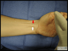 white=flex palm long
red=flex carp radialus. 
Inject beween the two, needle down to bone and withdraw a couple of mls. 