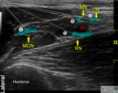 Axillaryarm block U/S presented similar to this ultrasound image. Nerves marked with numbers 1-4.


Patienthaving an operation of a lacerated index finger under regional anaesthesia.Which combination will provide adequate cover? 
 A) 1 and 2    
 ...